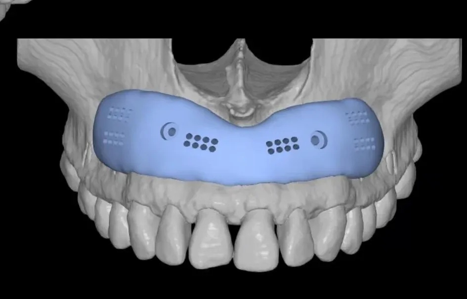 Biovolume Subnasal