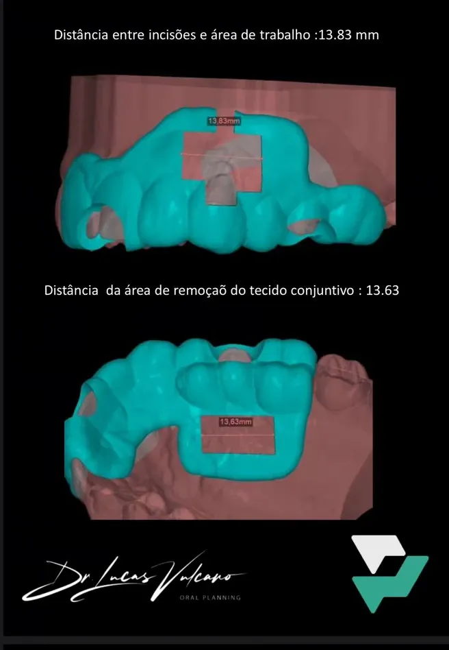 Guia de Recobrimento Radicular