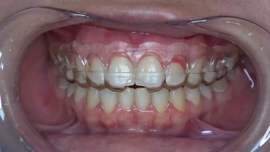 Perioguide — Cirurgia Guiada Periodontal