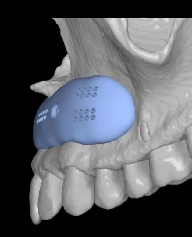 Biovolume subnasal em uso