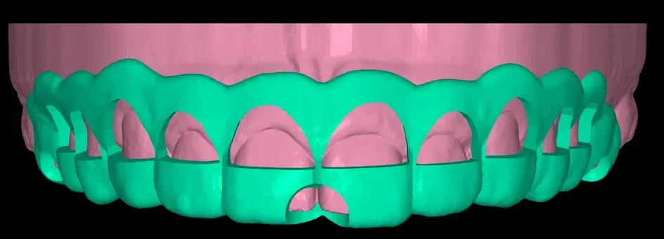 Guia periodontal em uso